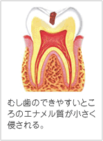 むし歯のできやすいところのエナメル質が小さく侵される。