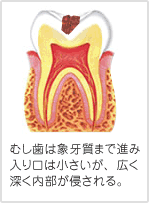 むし歯は象牙質まで進み入り口は小さいが、広く深く内部が侵される。